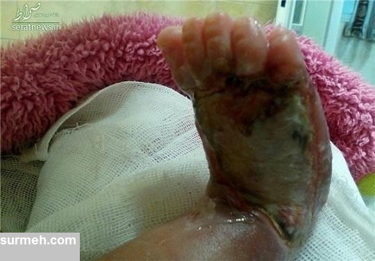 سوختن نوزاد 6 روزه به دلیل قصور پزشکی + عکس
